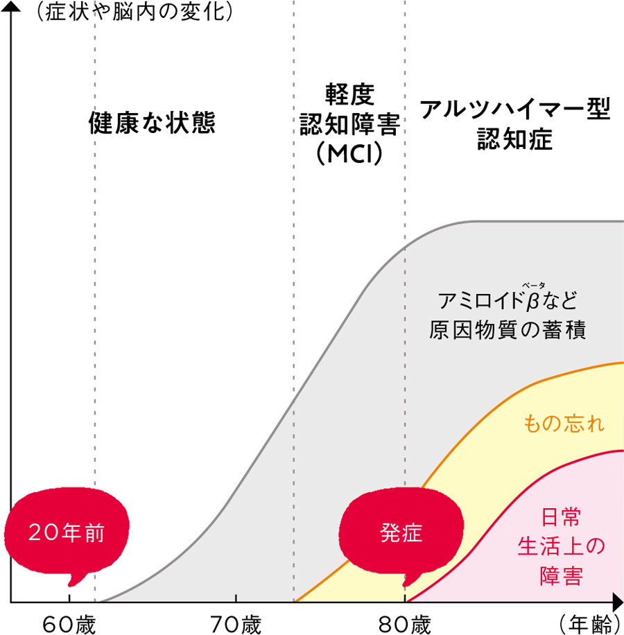 （症状や脳内の変化）健康な状態 軽度認知障害（MCI）アルツハイマー型認知症 アミロイドβ（ベータ）など原因物質の蓄積 もの忘れ 日常生活上の障害 60歳 20年前 80歳 発症 （年齢）