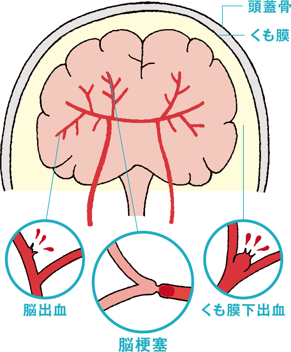 頭蓋骨 くも膜 脳出血 くも膜下出血 脳梗塞