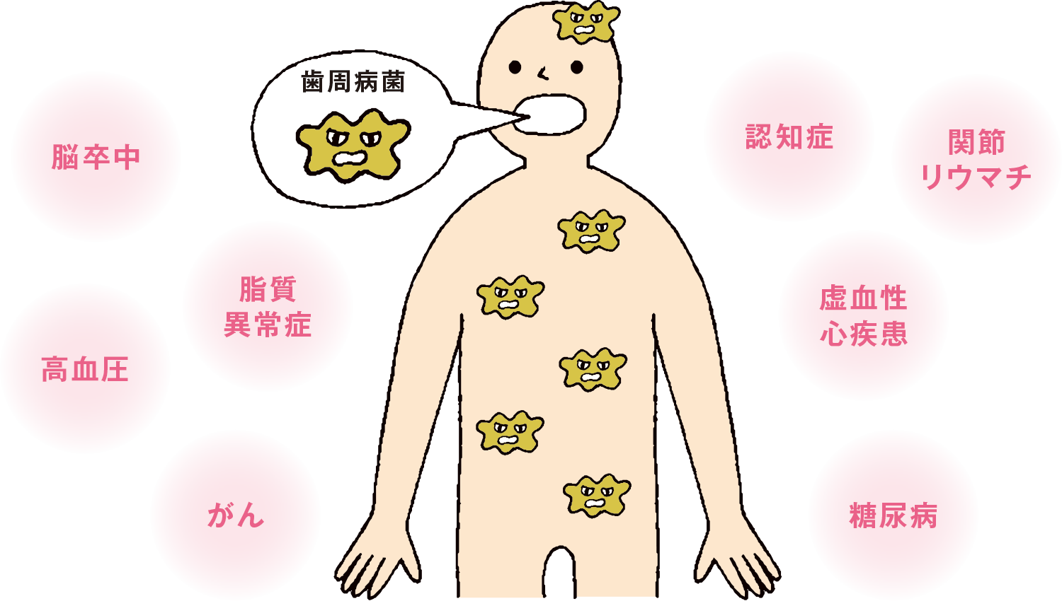 歯周病菌　脳卒中　脂質異常症　高血圧　がん　認知症　関節リウマチ　虚血性心疾患　糖尿病